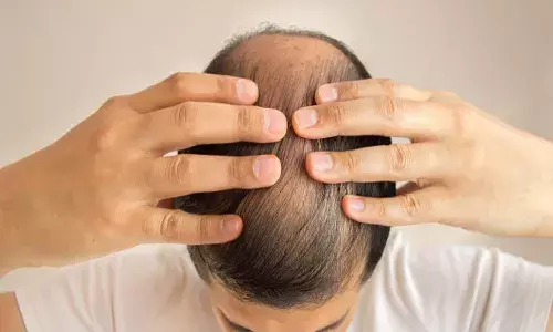 Woman seeks divorce from husband for hiding baldness before marriage