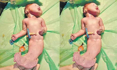 Different child delivered in Hyderabad