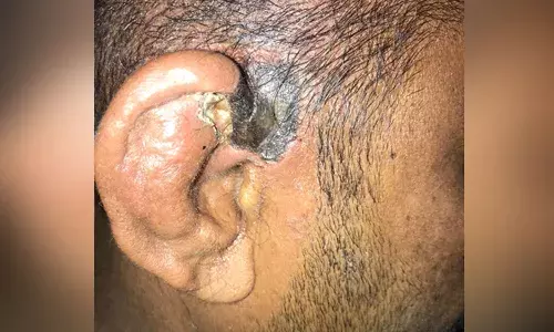 మరో టెన్షన్.. స్కిన్ బ్లాక్ ఫంగస్.. తొలి కేసు నమోదు