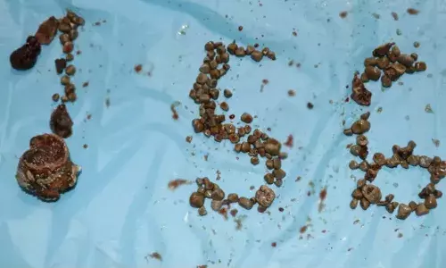 కడుపులో నుండి 156 రాళ్లను బయటకు తీసిన వైద్యులు