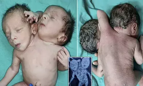 రెండు తలలు, మూడు చేతులతో.. అరుదైన శిశువు జననం