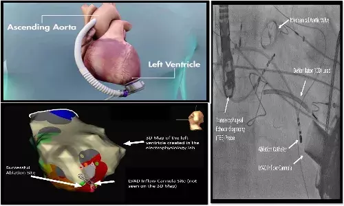 తీవ్ర హృద్రోగంతో బాధపడుతున్న యువకునికి కృత్రిమ గుండె సహాయంతో విజయవంతమైన చికిత్స