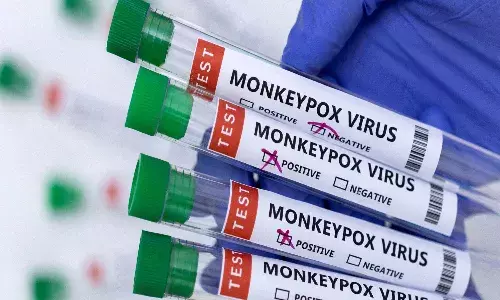 యూపీలో ఐదేళ్ల బాలికకు మంకీపాక్స్..?