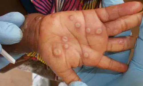 విజయవాడలో మంకీ పాక్స్‌ అనుమానిత కేసు కలకలం