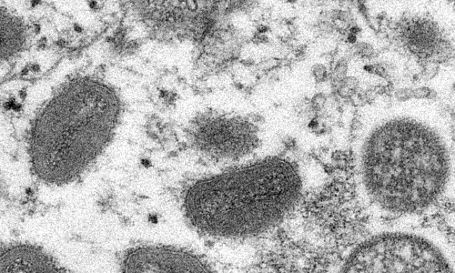 ఒకే వ్యక్తిలో కరోనా, మంకీపాక్స్‌ నిర్ధారణ..!