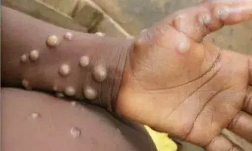 కామారెడ్డి జిల్లాలో మంకీపాక్స్ కలకలం