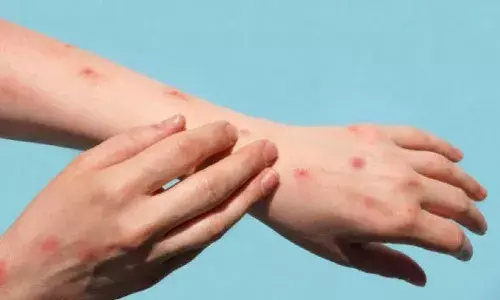 మంకీపాక్స్ భయం.. మశూచి వ్యాక్సిన్కు పెరిగిన డిమాండ్