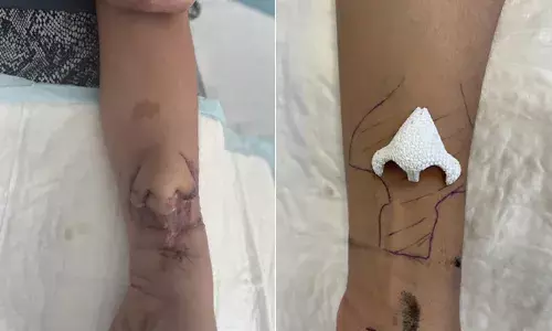 నిజంగా అద్భుతమే.. చేతిపై ముక్కును పెంచి.. ముఖానికి అతికించిన ఫ్రాన్స్ వైద్యులు