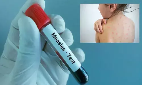 ముంబైలో మీజిల్స్ వ్యాధి విజృంభ‌ణ‌.. చిన్నారి మృతి