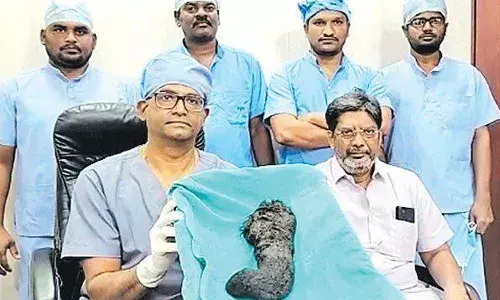 14 ఏళ్ల బాలిక కడుపులో కిలో జుట్టు.. తొలగించిన వైద్యులు