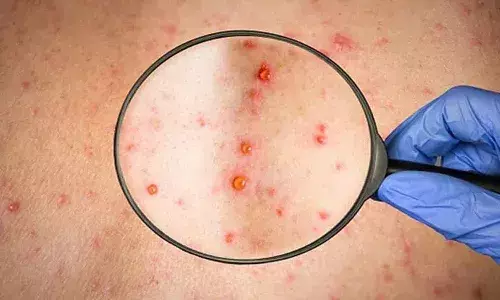 స్కూల్లో కలకలం.. 20 మంది పిల్లలకు, టీచర్కు సోకిన చికెన్పాక్స్