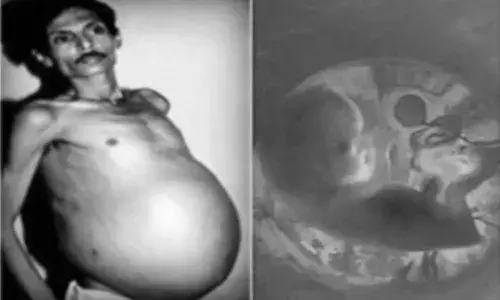 షాకింగ్.. 36 ఏళ్లు గర్భంతో పురుషుడు..!