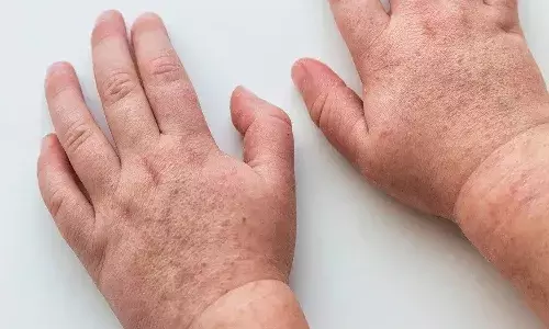 mumps, scarlet fever,  hyderabad,  dry weather,