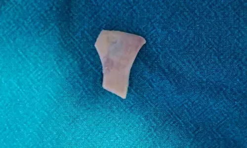 Kamineni doctors, mutton bone, old man, Hyderabad