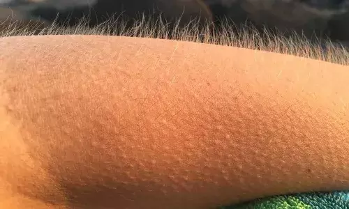 goosebumps, Goosebumps Reasons, Skin, Hair