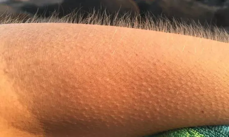 goosebumps, Goosebumps Reasons, Skin, Hair