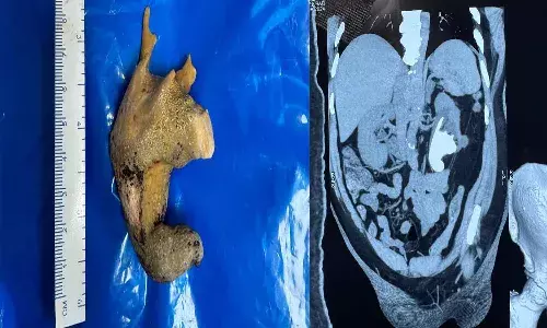 దుప్పికొమ్ము ఆకారంలో రాయి.. వైజాగ్ లో అరుదైన శస్త్ర చికిత్స