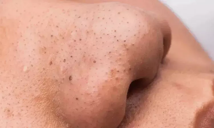 black nose, Chikungunya, Health News