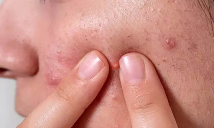 acne, Health, life style