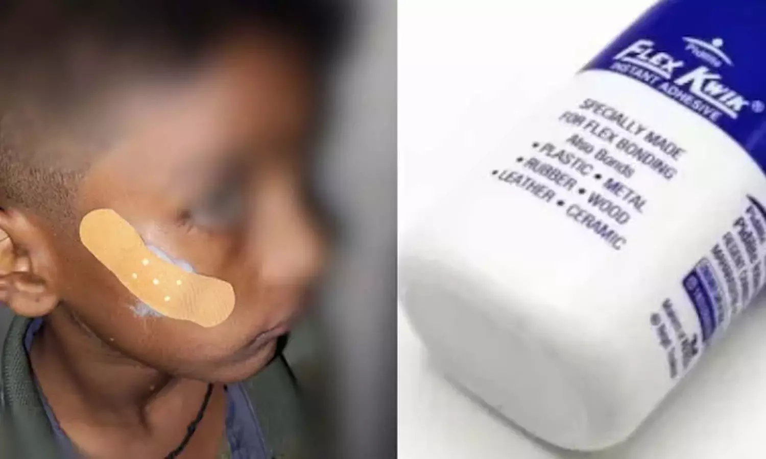 Karnataka, nurse, Fevikwik, child, Crime