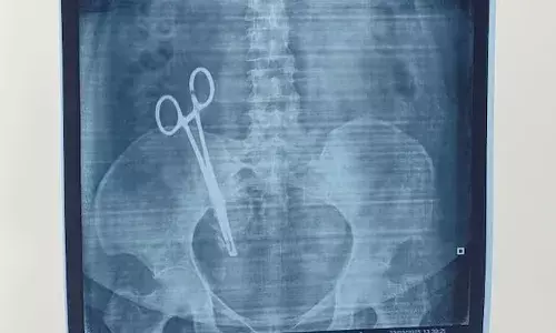 Scissors left in woman stomach, C-section, Lucknow