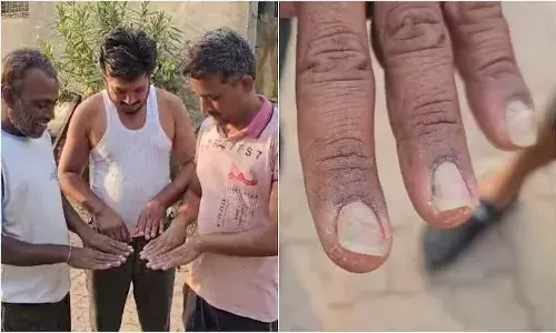 National News, Maharastra, Buldhana Shegaon, Nail Problems