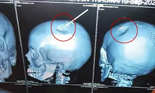 Chittoor District, Private school, teacher booked, hitting girl, causing skull fracture, APnews