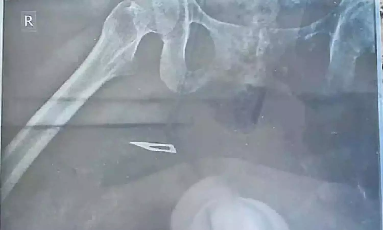 Doctors leave blade in woman thigh, surgery, Govt Hospital, Narasaraopet, 5 suspended