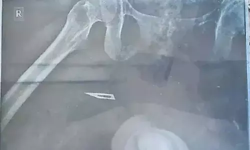 Doctors leave blade in woman thigh, surgery, Govt Hospital, Narasaraopet, 5 suspended Doctors leave blade in woman thigh, surgery, Govt Hospital, Narasaraopet, 5 suspended