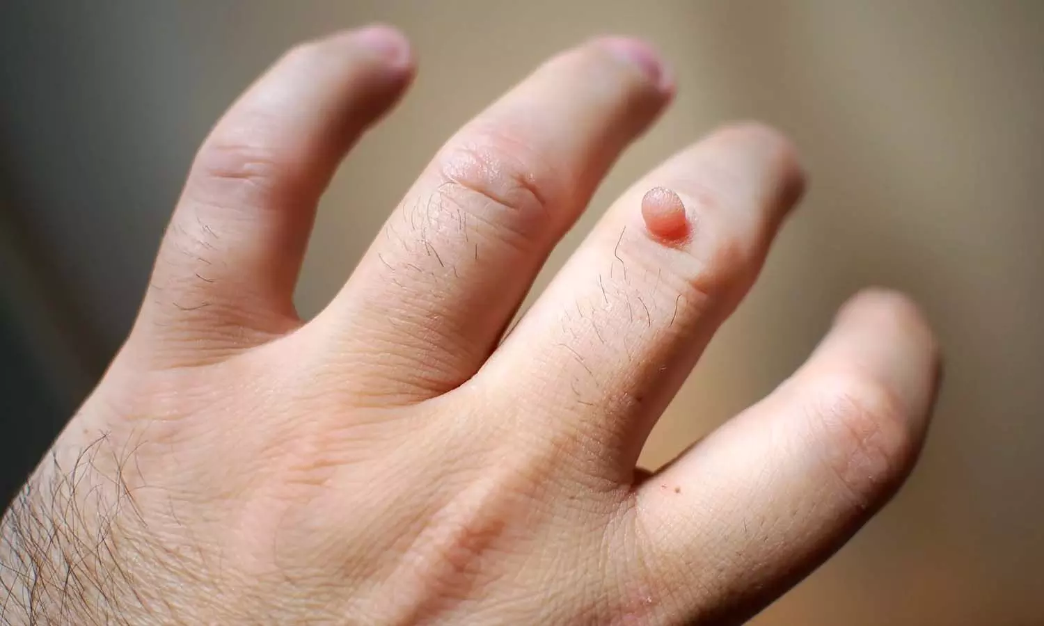 Health Tips, warts, warts reduce, human body Health Tips, warts, warts reduce, human body