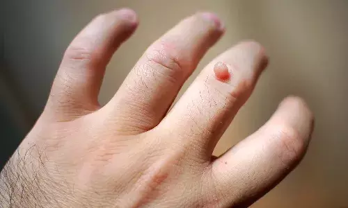 Health Tips, warts, warts reduce, human body Health Tips, warts, warts reduce, human body