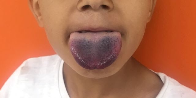 Tongue Tied Whe 431440